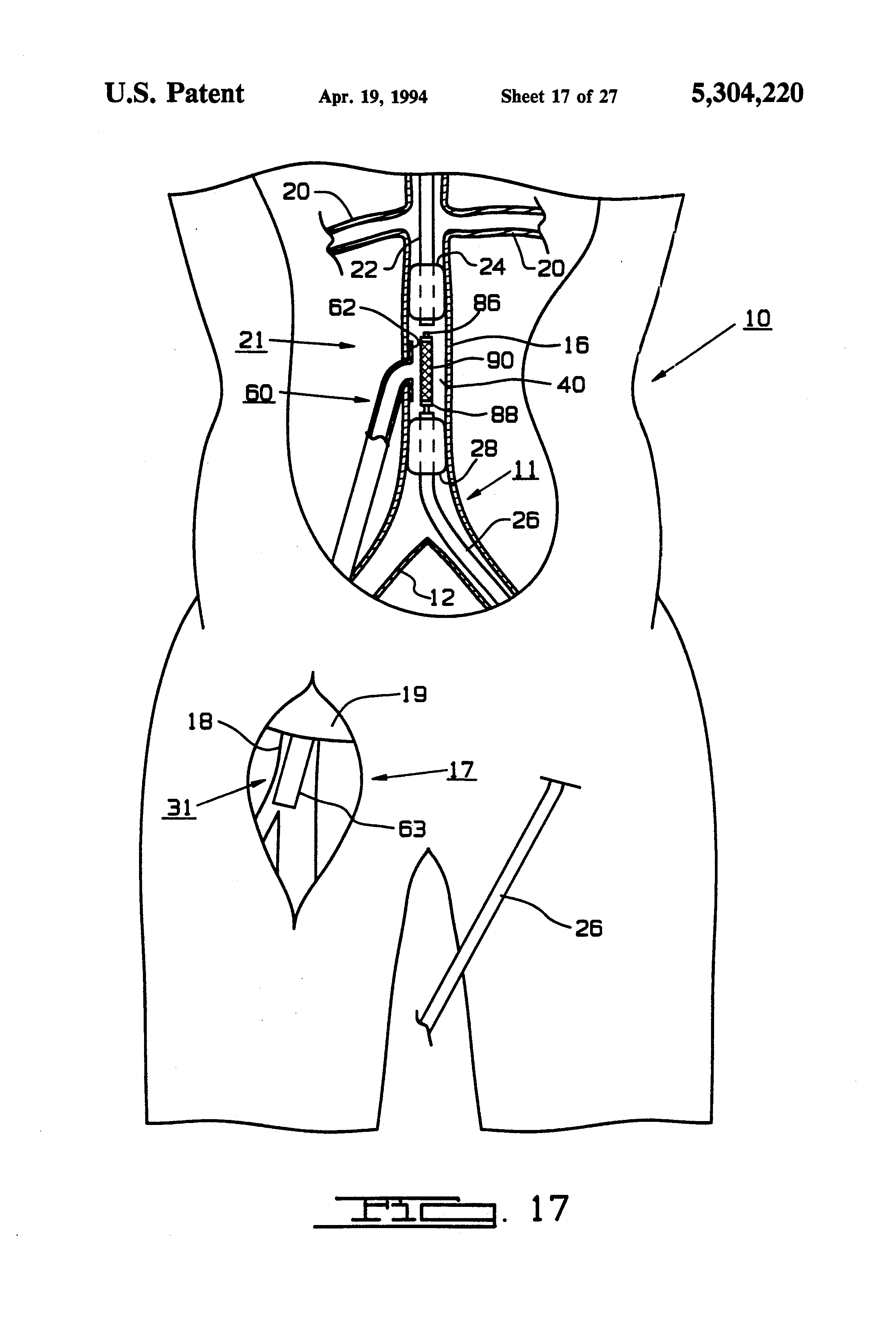 prothesis gr prothesis gr
