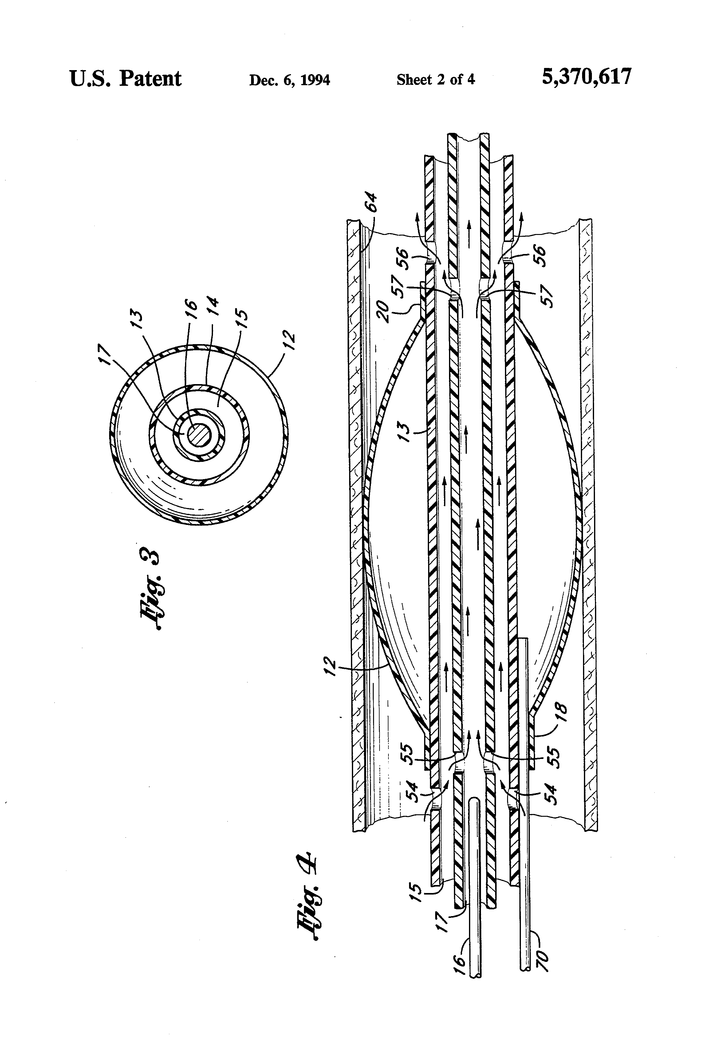 blood perfusion balloon catheter