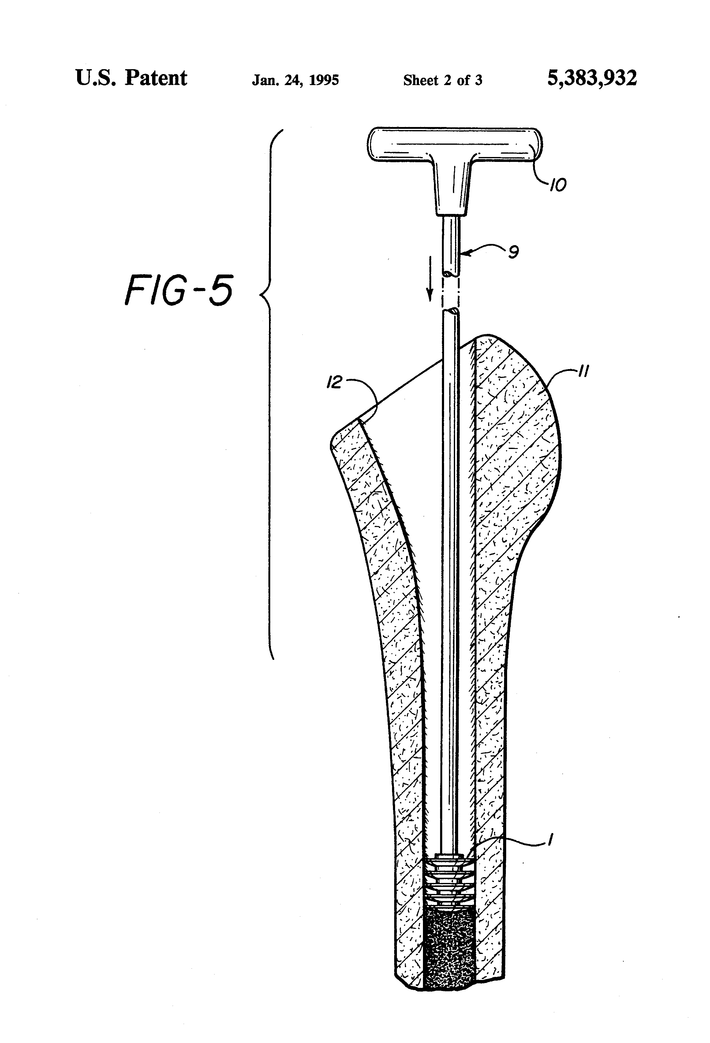 Patent US5383932 - Absorbable medullary plug - Google Patents