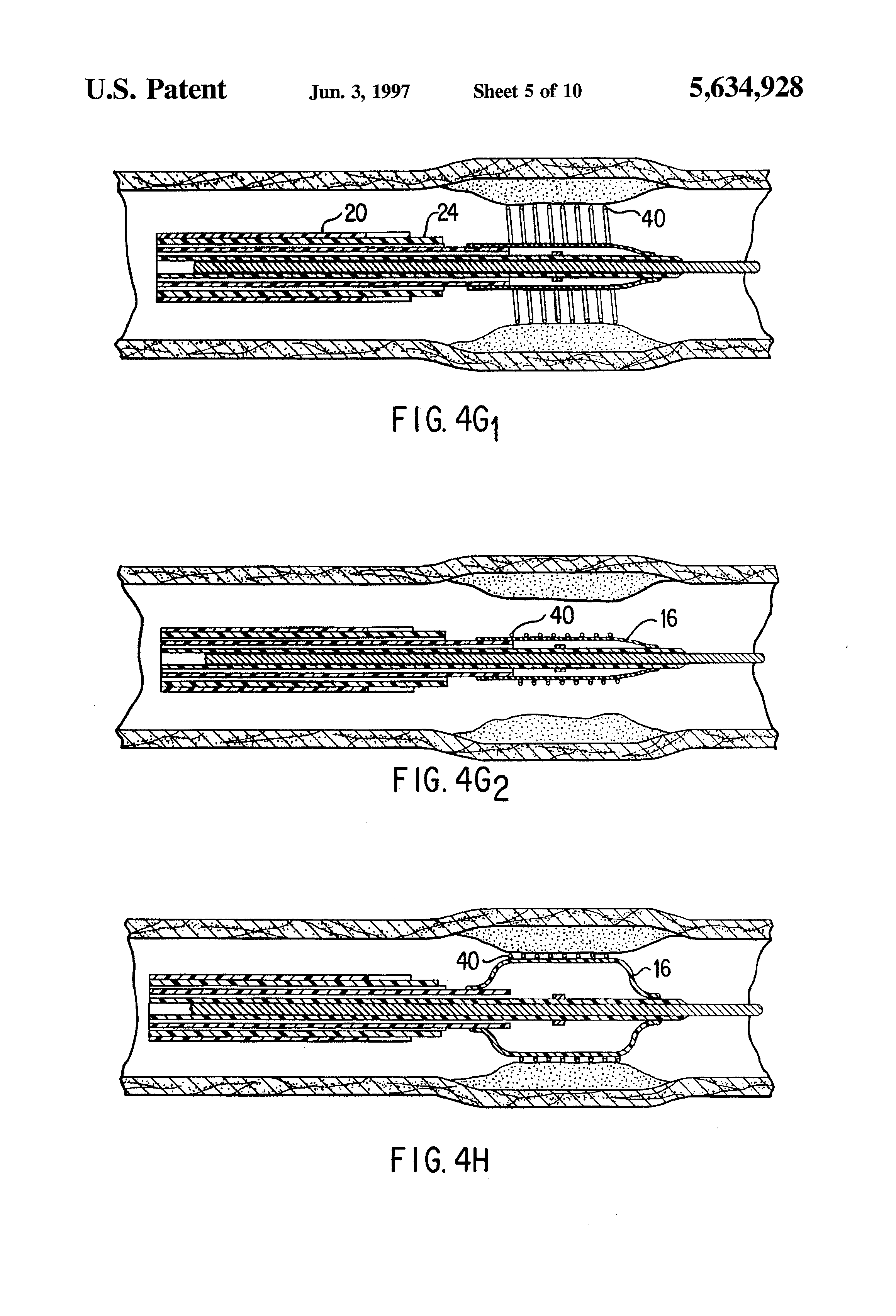balloonangioplasty,n,fin_大山谷图库