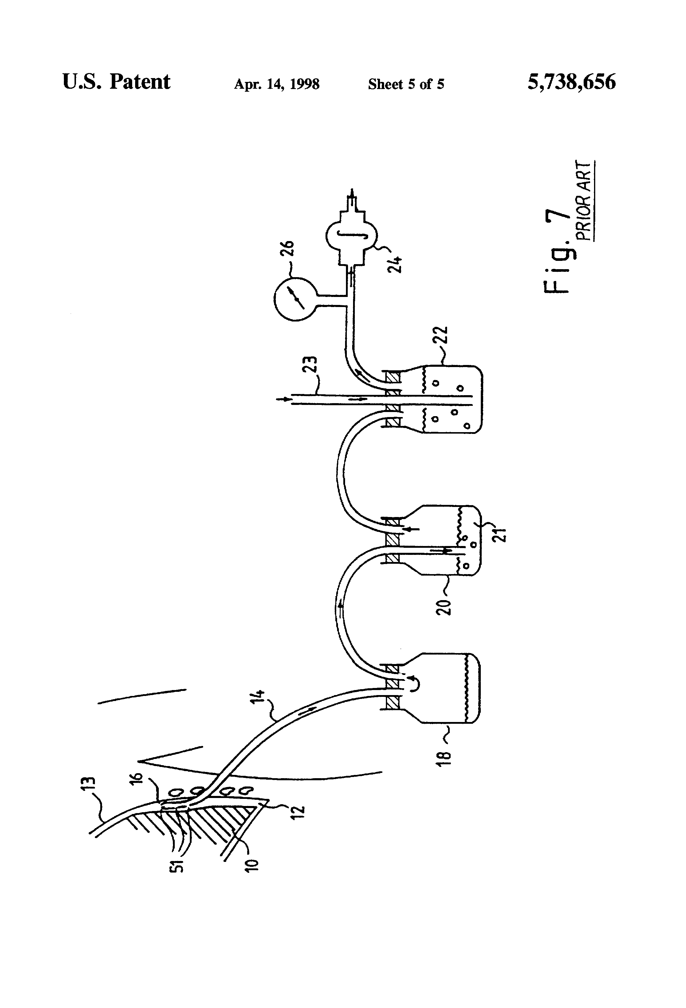 for removing fluids from a pleural cavity by suction