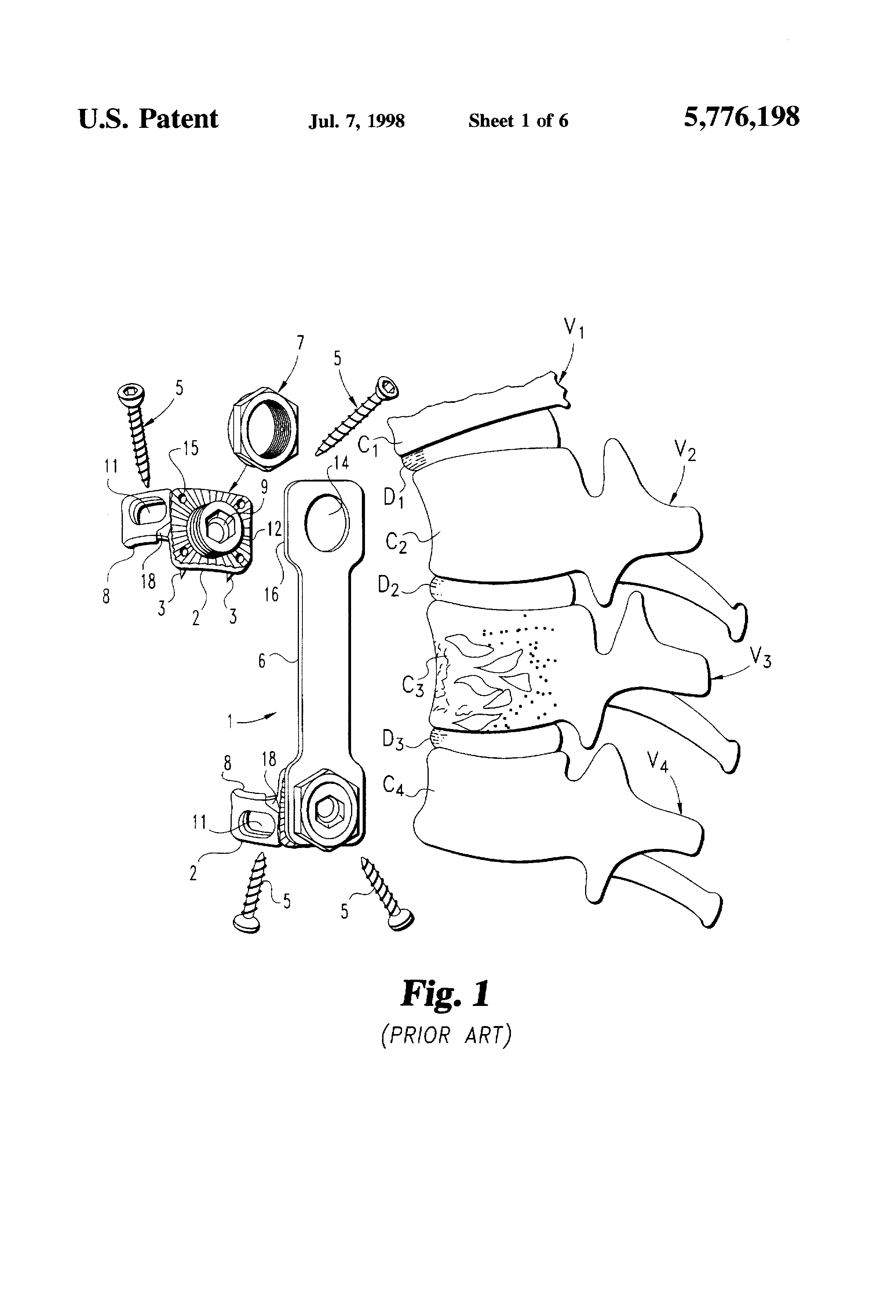 adjustable vertebral body replacement