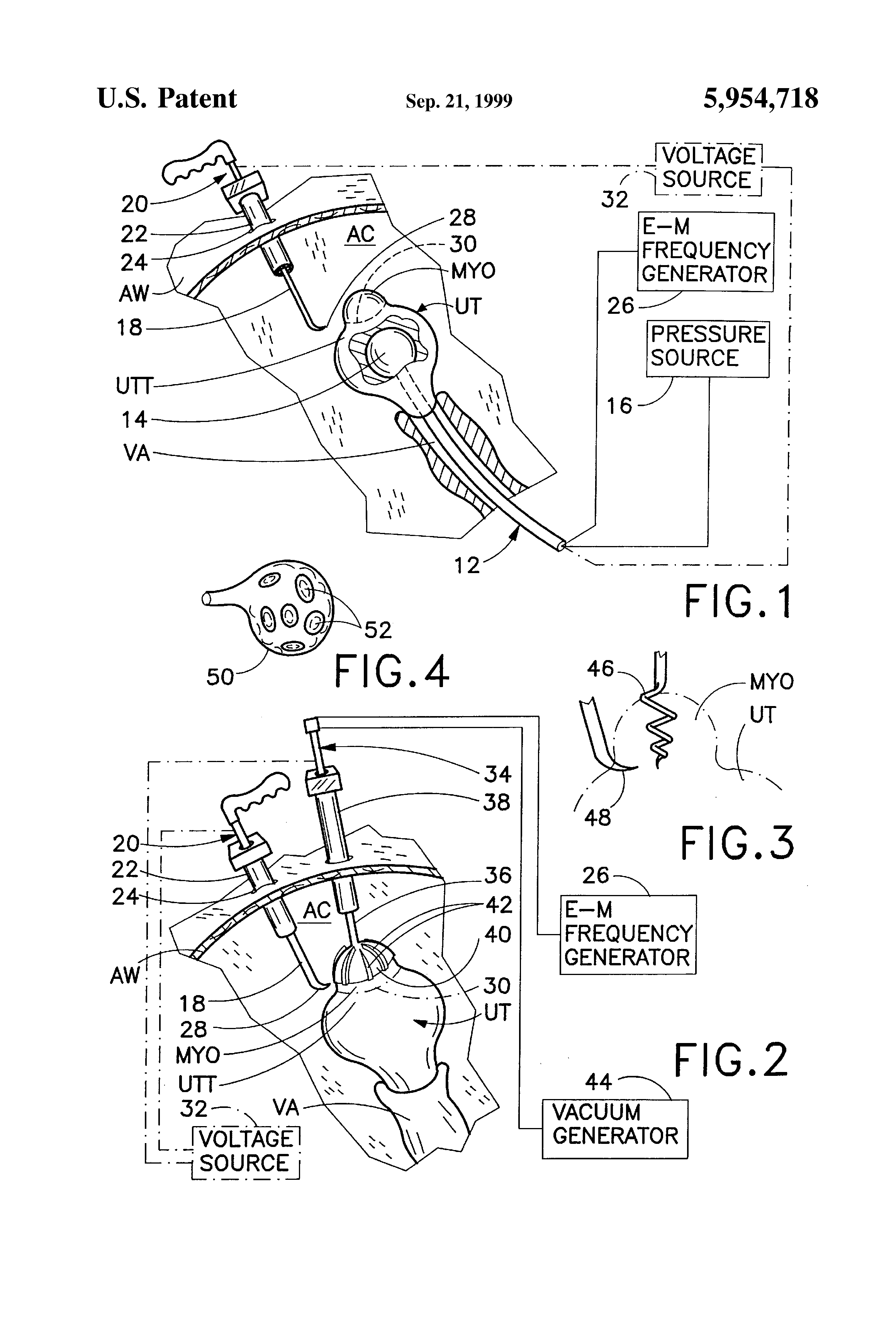 myoma removal technique and associated surgical device
