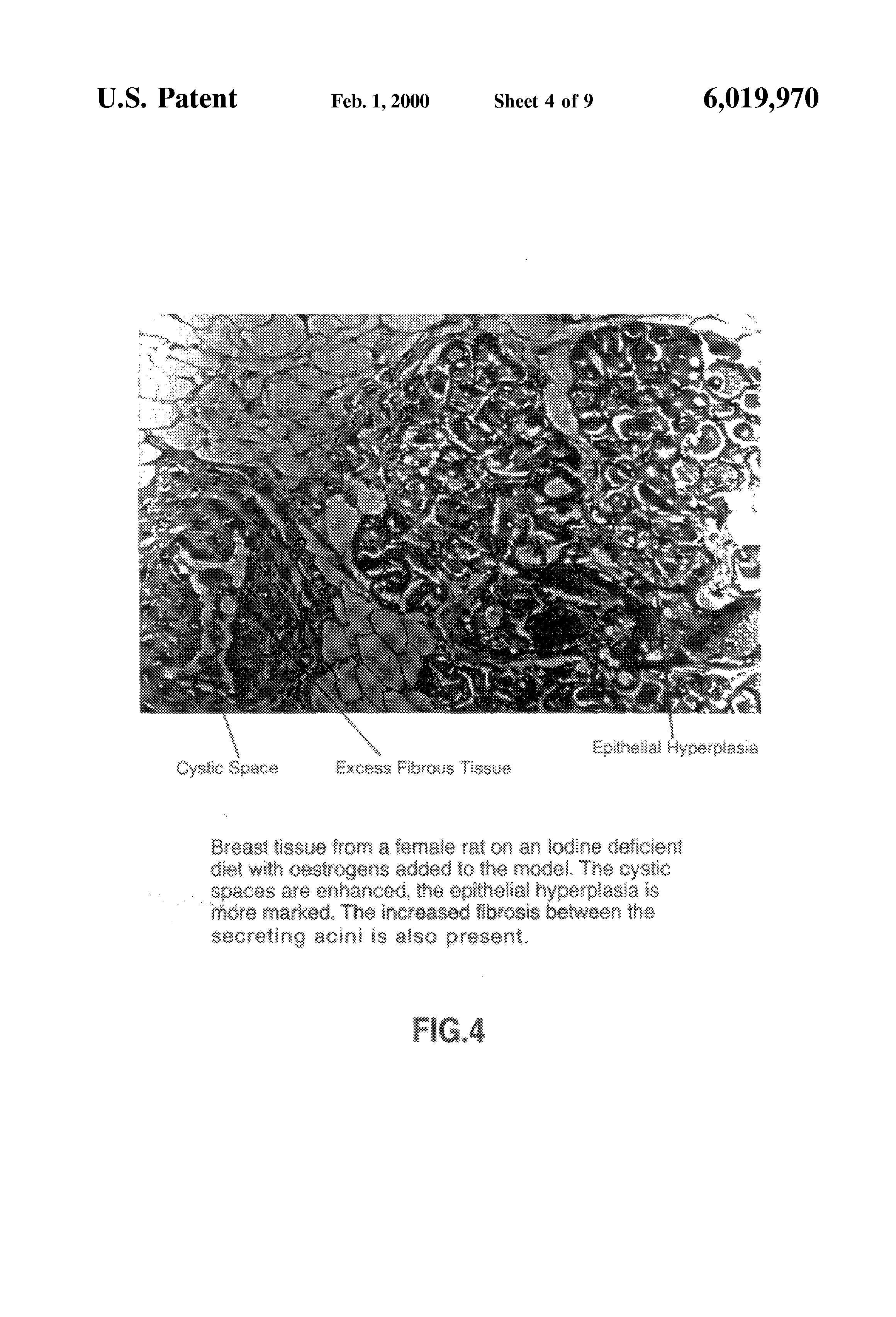 iodine deficiency diseases essay iodine deficiency diseases essay